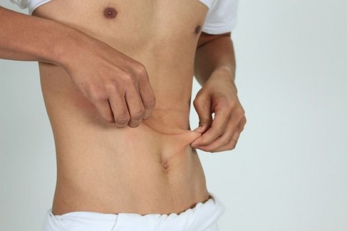 Abdominoplastia circunferencial en hombres con pérdida masiva de peso