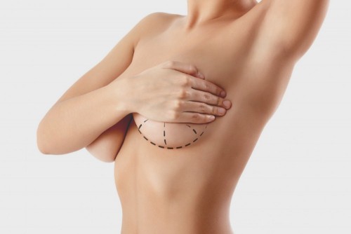 Plexia mamaria con implantes: Análisis de complicaciones y eventualidades